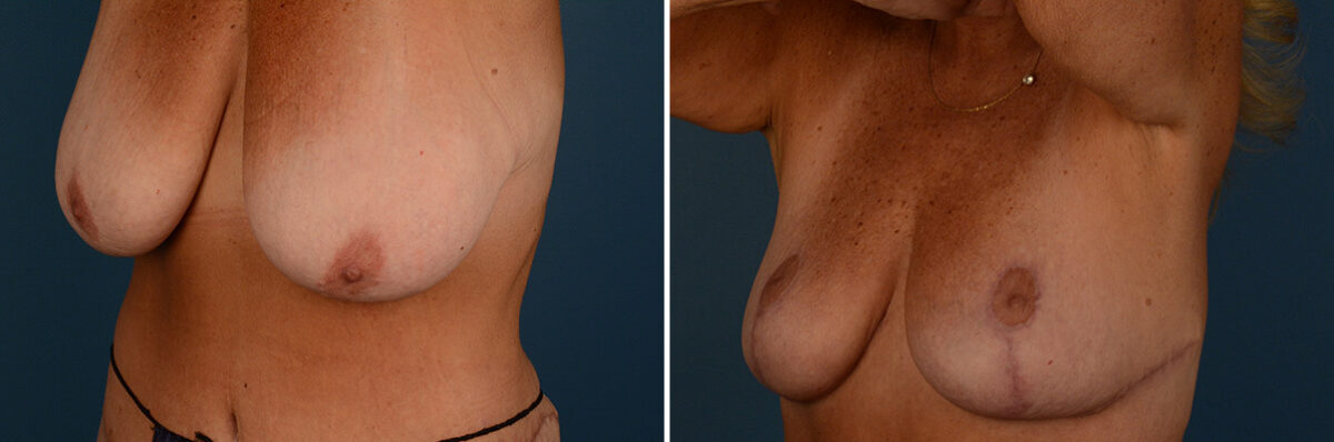 Breast Lift Before and After Photos in Naples, FL, Patient 30796