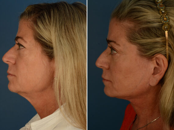 Cheek Implants Before and After Photos in Naples, FL, Patient 30833