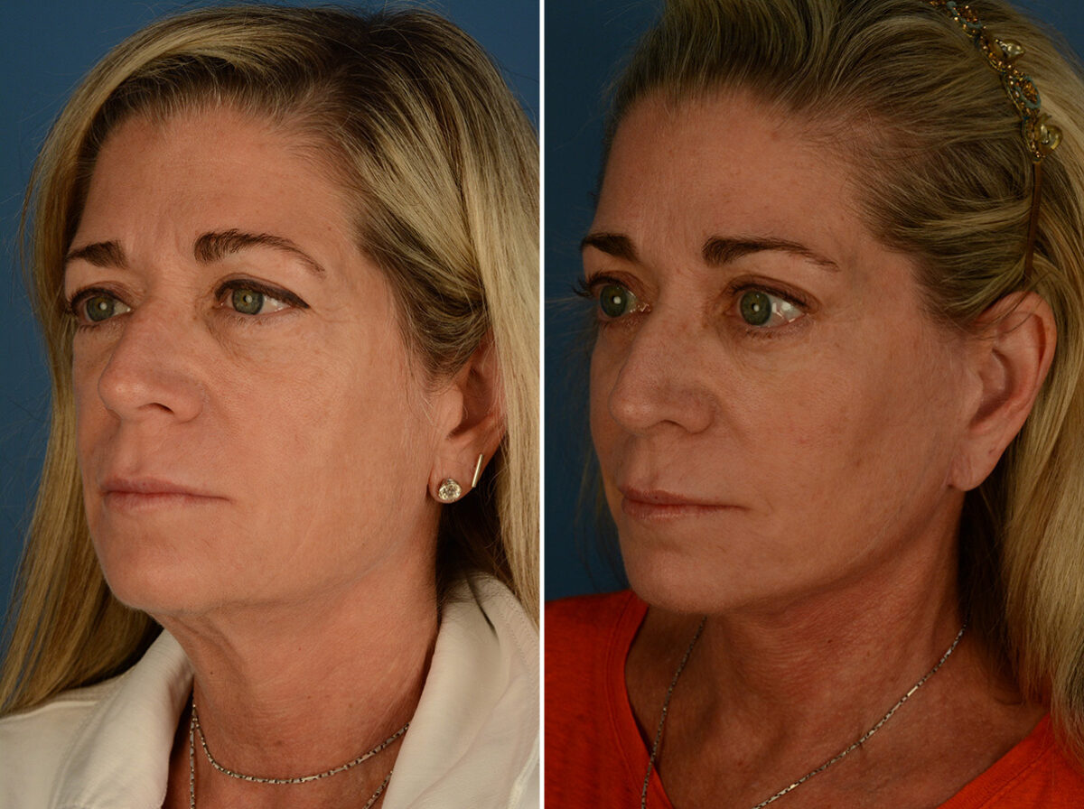 Cheek Implants Before and After Photos in Naples, FL, Patient 30833