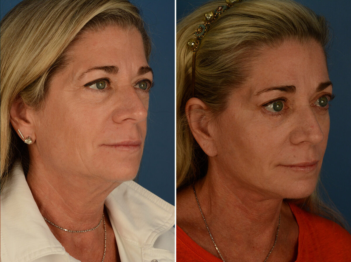Cheek Implants Before and After Photos in Naples, FL, Patient 30833