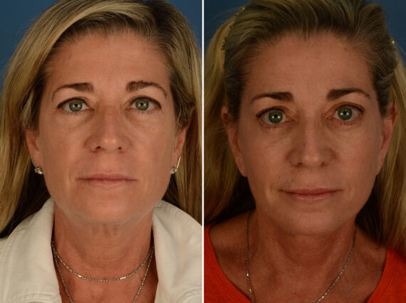 Cheek Implants Before and After Photos in Naples, FL, Patient 30833