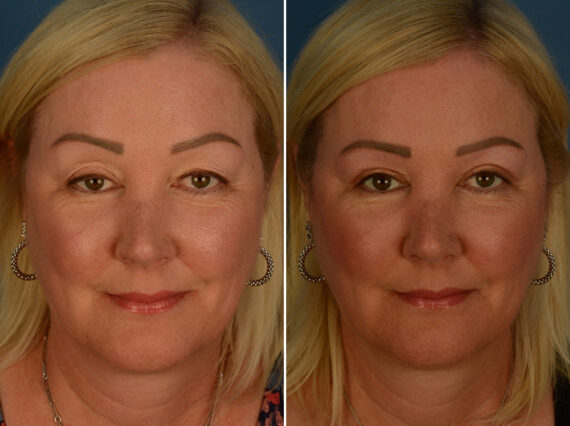 Blepharoplasty Before and After Photos in Naples, FL, Patient 30982