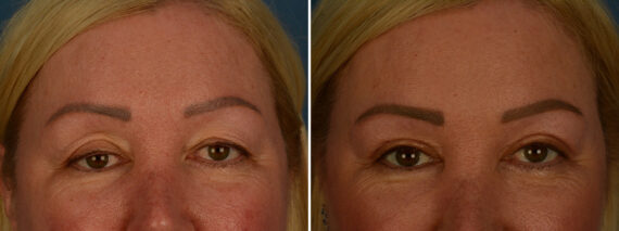 Blepharoplasty Before and After Photos in Naples, FL, Patient 30982