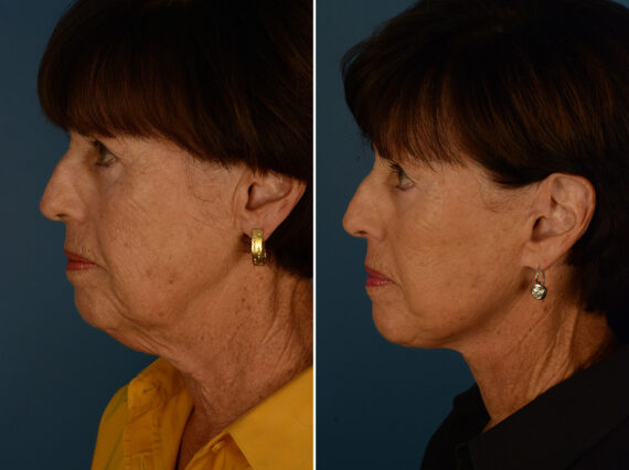 The UpLift™ Lower Face and Neck Lift Before and After Photos in Naples, FL, Patient 31184