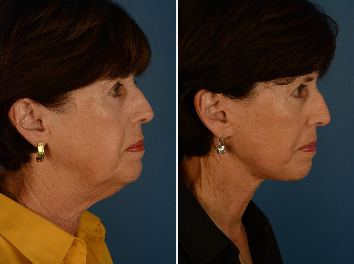 The UpLift™ Lower Face and Neck Lift Before and After Photos in Naples, FL, Patient 31184