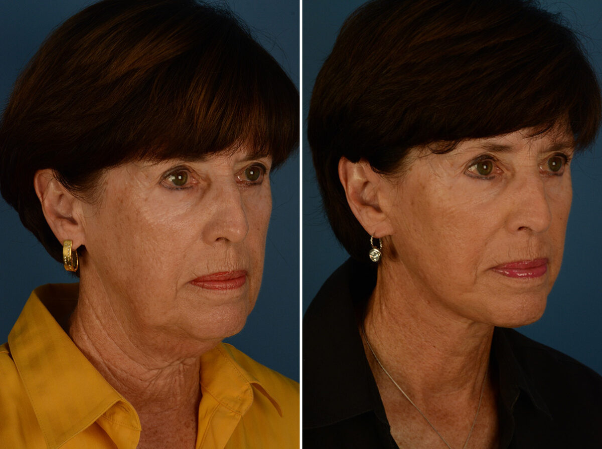 The UpLift™ Lower Face and Neck Lift Before and After Photos in Naples, FL, Patient 31184