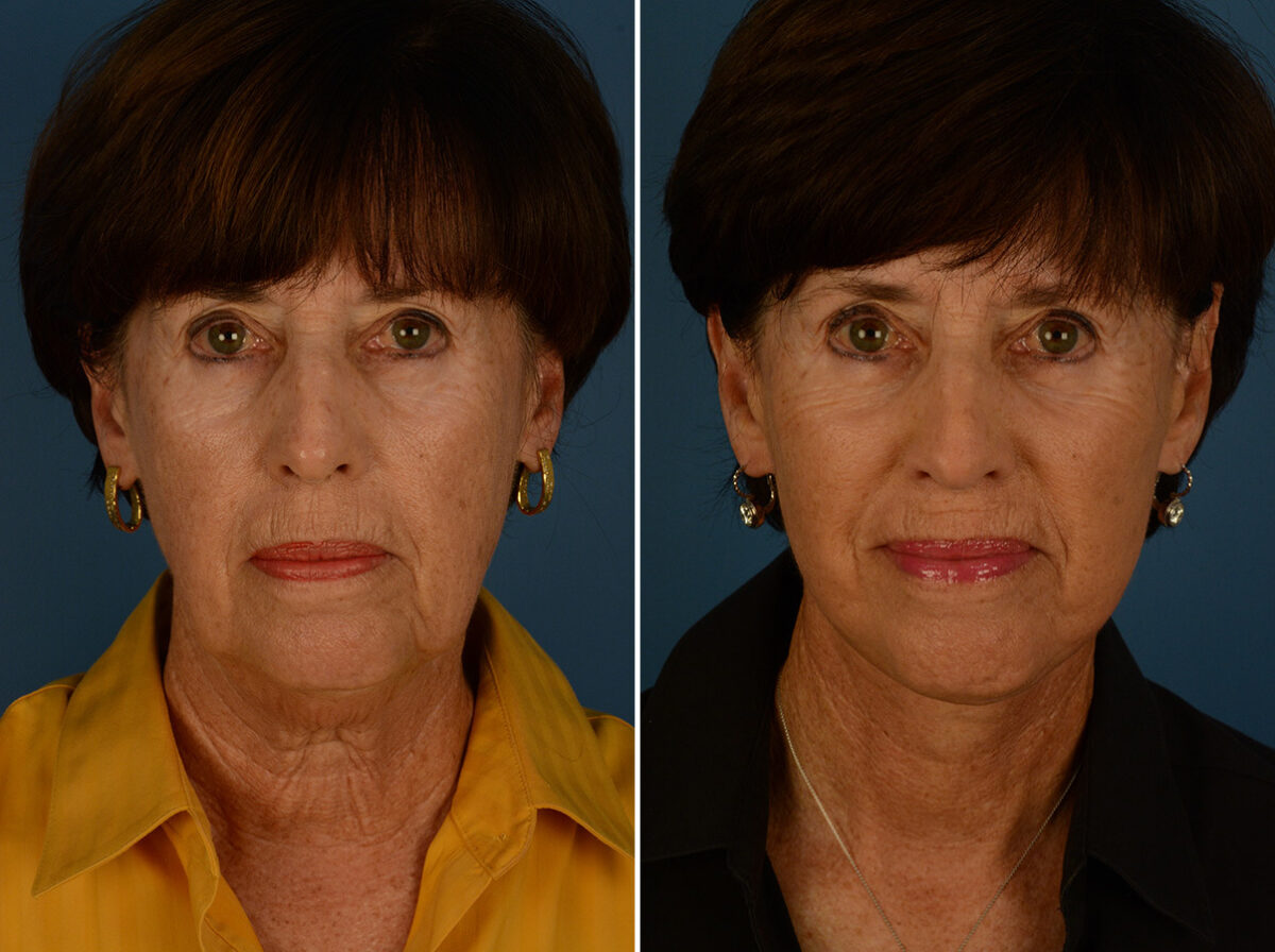 The UpLift™ Lower Face and Neck Lift Before and After Photos in Naples, FL, Patient 31184