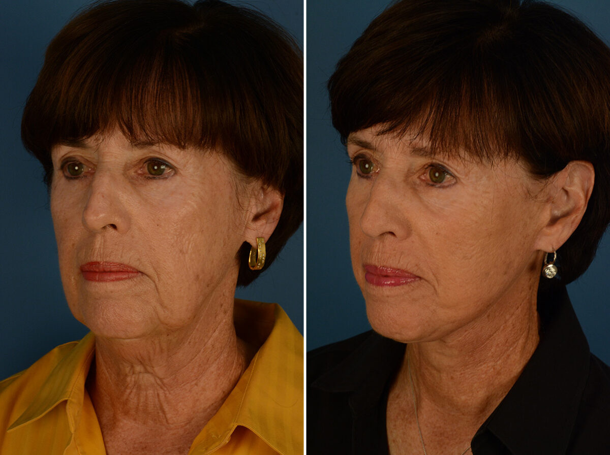 The UpLift™ Lower Face and Neck Lift Before and After Photos in Naples, FL, Patient 31184