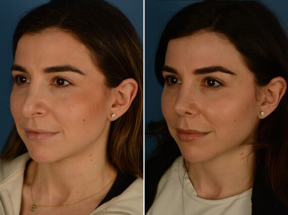 Revision Rhinoplasty Before and After Photos in Naples, FL, Patient 31335