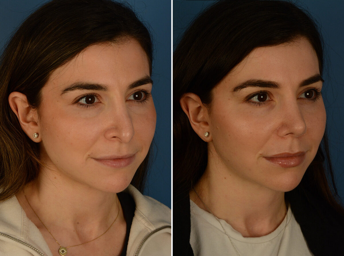 Revision Rhinoplasty Before and After Photos in Naples, FL, Patient 31335