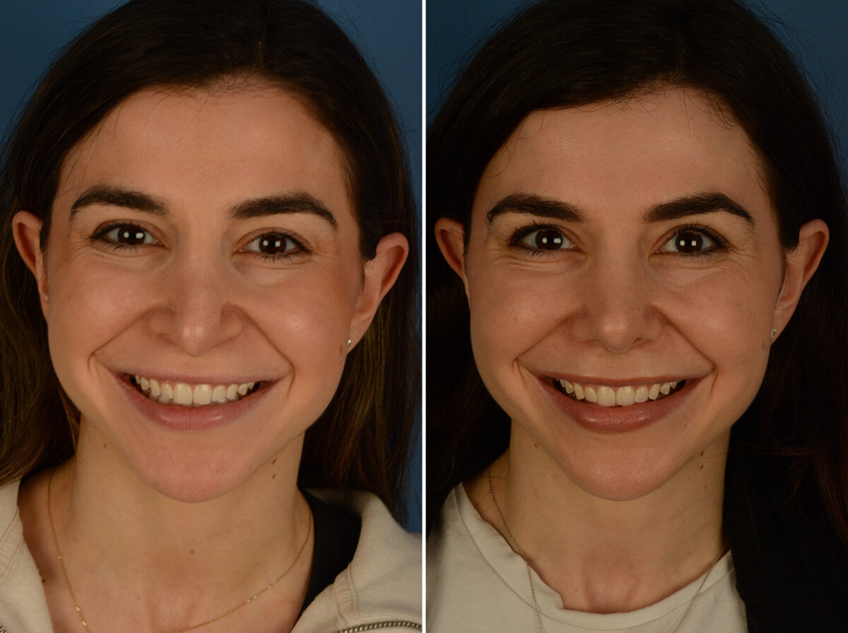 Revision Rhinoplasty Before and After Photos in Naples, FL, Patient 31335