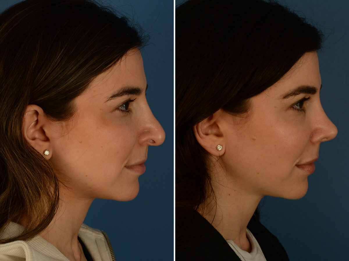 Revision Rhinoplasty Before and After Photos in Naples, FL, Patient 31335