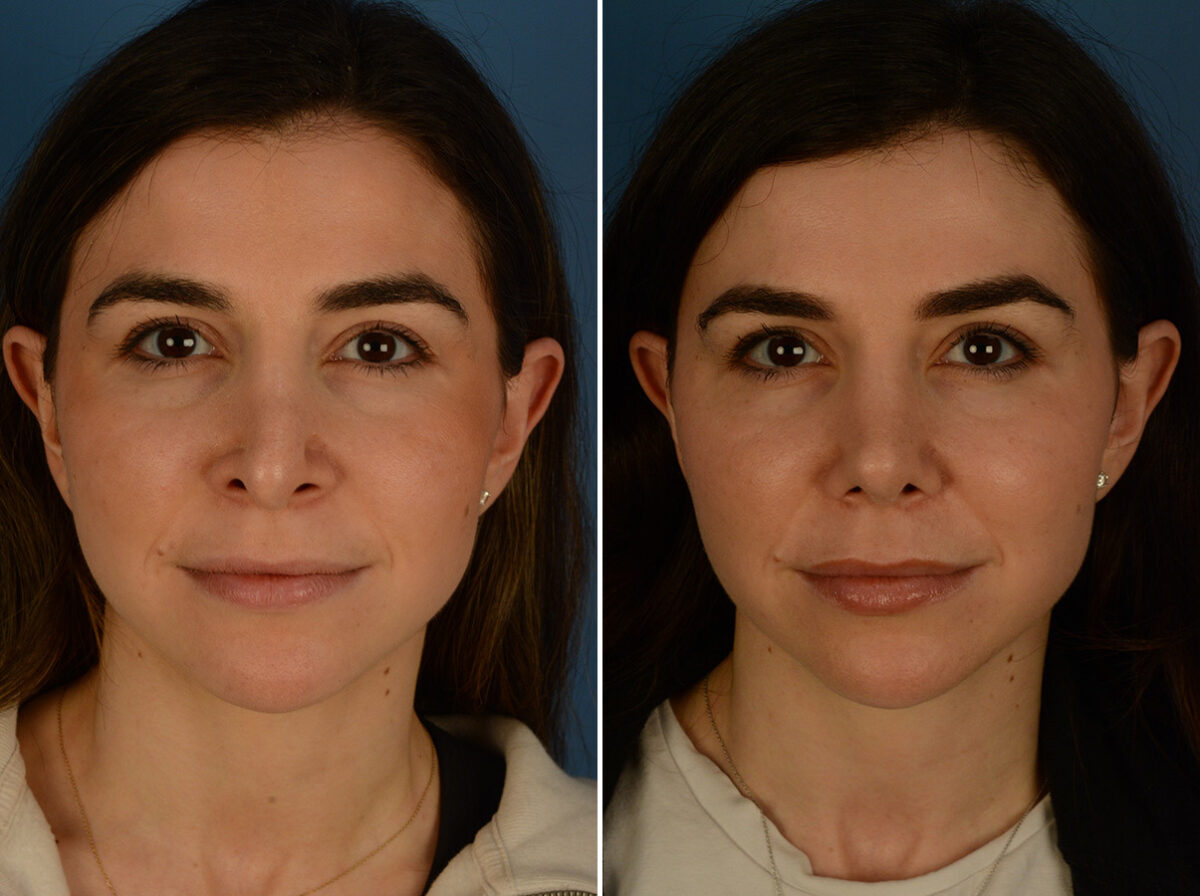 Revision Rhinoplasty Before and After Photos in Naples, FL, Patient 31335