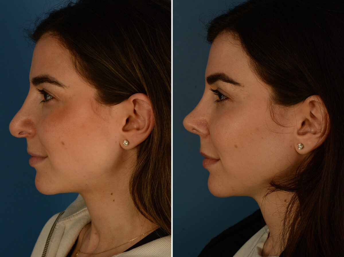 Revision Rhinoplasty Before and After Photos in Naples, FL, Patient 31335