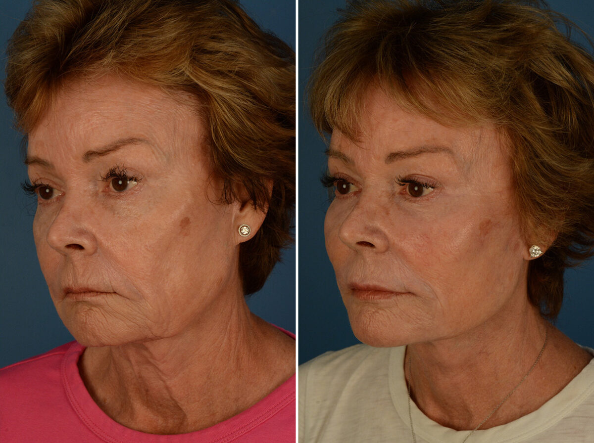 Endoscopic Facelift Before and After Photos in Naples, FL, Patient 31357