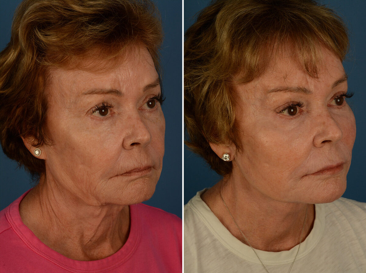 Endoscopic Facelift Before and After Photos in Naples, FL, Patient 31357