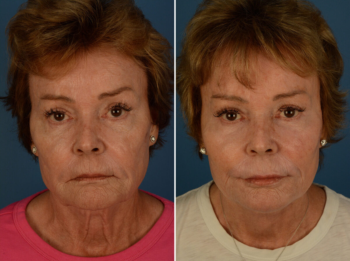 Endoscopic Facelift Before and After Photos in Naples, FL, Patient 31357