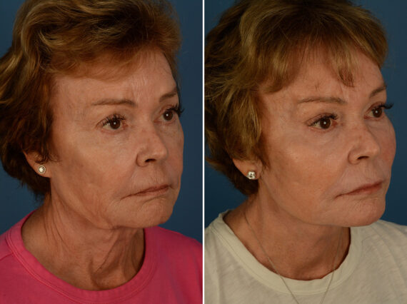 Endoscopic Facelift Before and After Photos in Naples, FL, Patient 31357