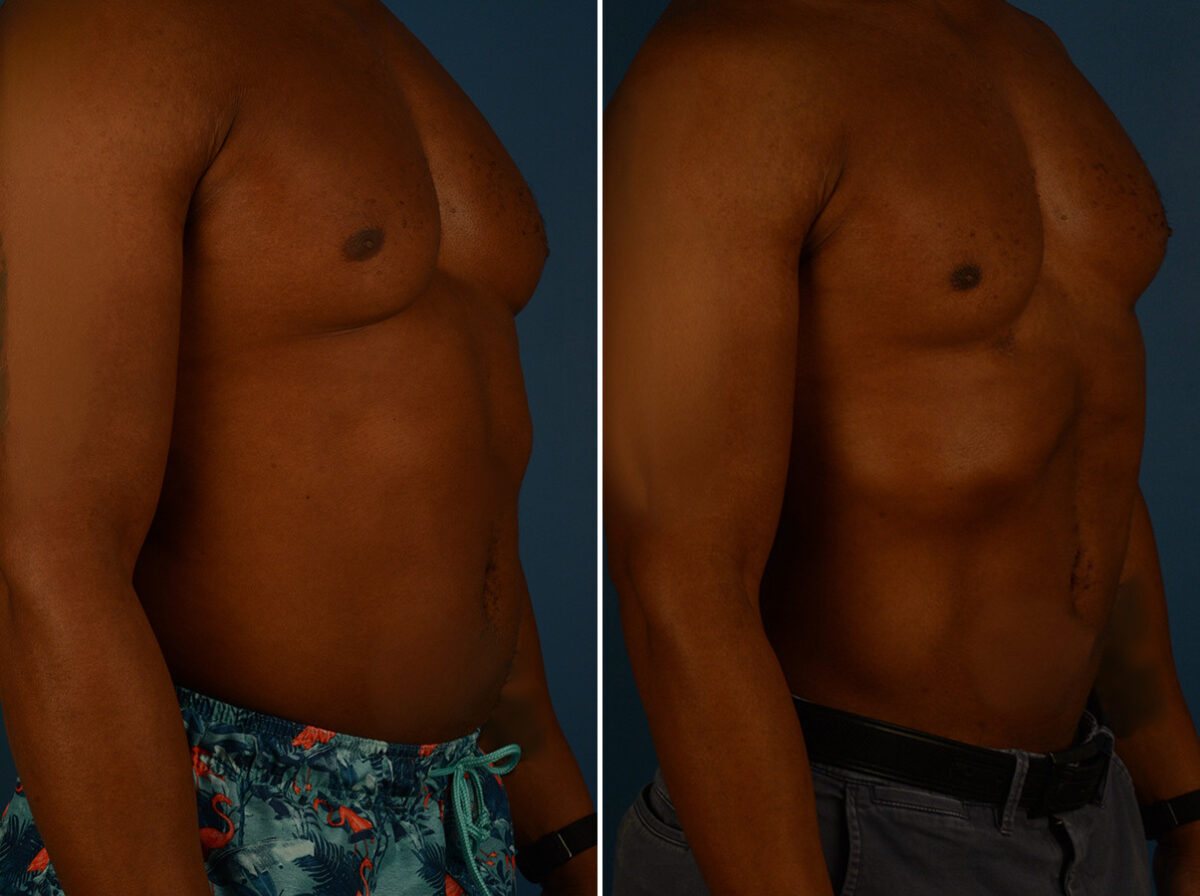 VASER® Liposuction with Renuvion Before and After Photos in Naples, FL, Patient 31464