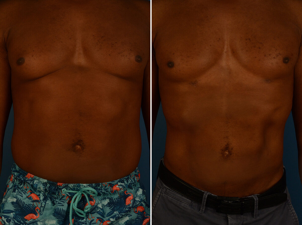 VASER® Liposuction with Renuvion Before and After Photos in Naples, FL, Patient 31464