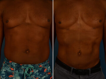 VASER® Liposuction with Renuvion Before and After Photos in Naples, FL, Patient 31464