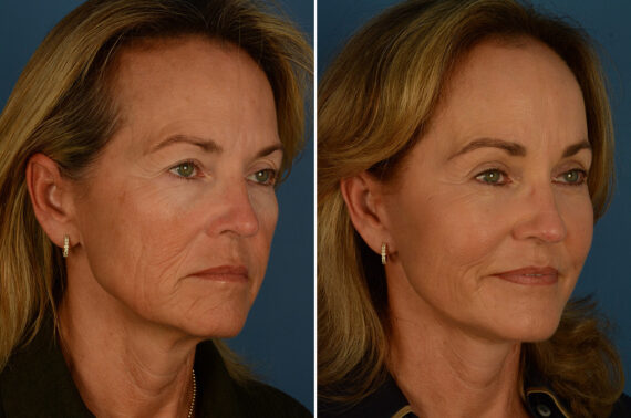 Fat Transfer Before and After Photos in Naples, FL, Patient 31481