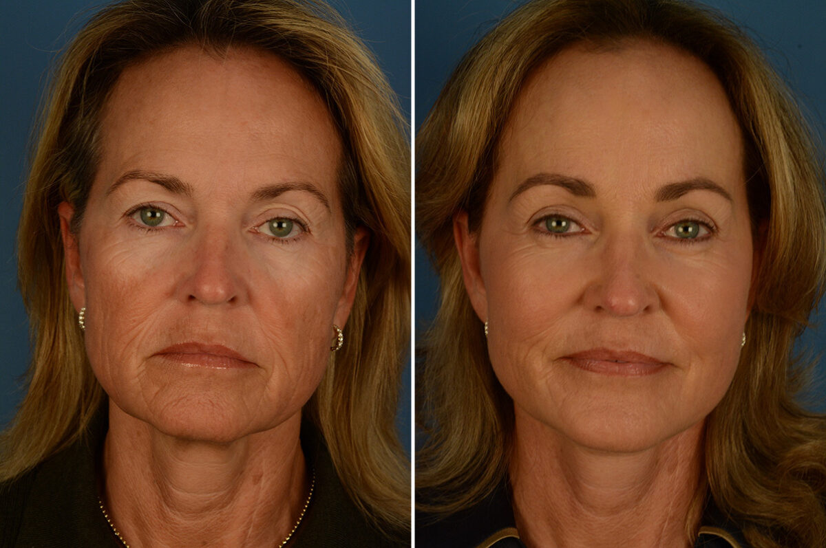Fat Transfer Before and After Photos in Naples, FL, Patient 31481