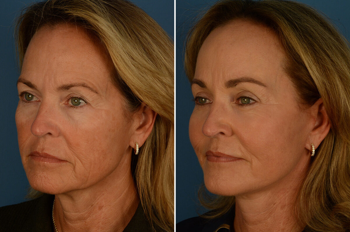 Fat Transfer Before and After Photos in Naples, FL, Patient 31481