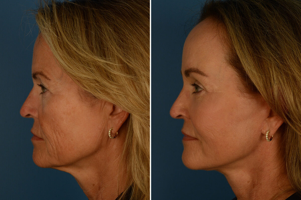 Fat Transfer Before and After Photos in Naples, FL, Patient 31481