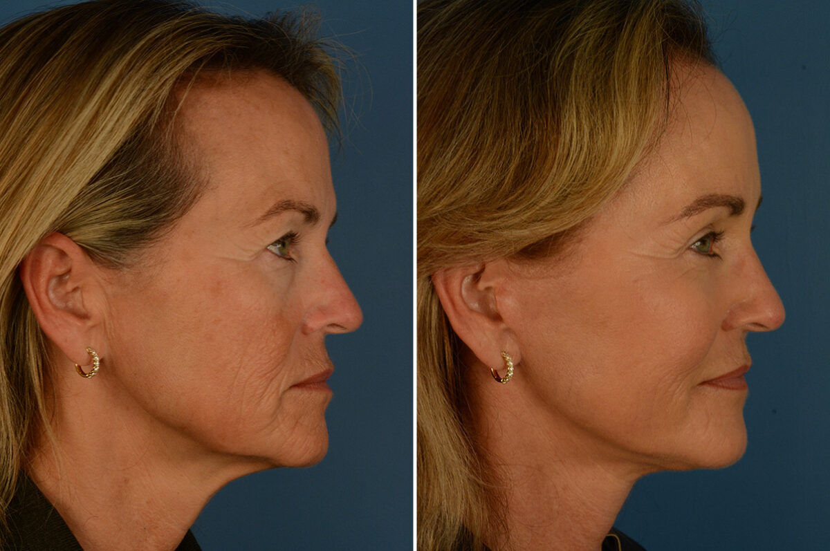 Fat Transfer Before and After Photos in Naples, FL, Patient 31481