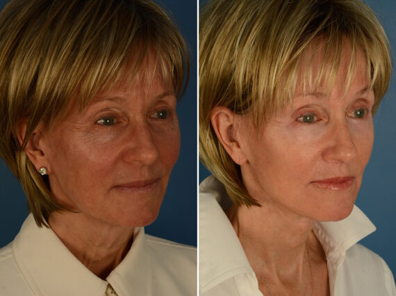 Lip Lift Before and After Photos in Naples, FL, Patient 31694