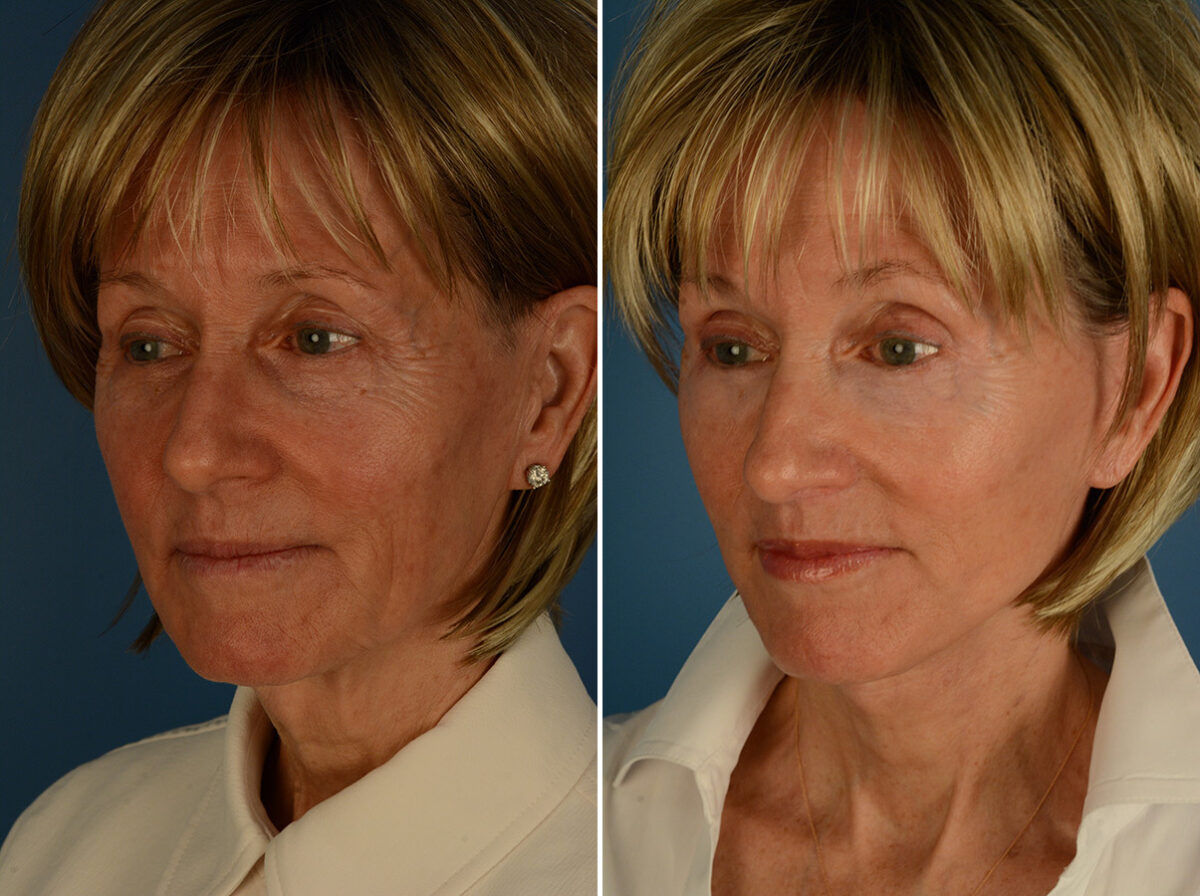 Lip Lift Before and After Photos in Naples, FL, Patient 31694