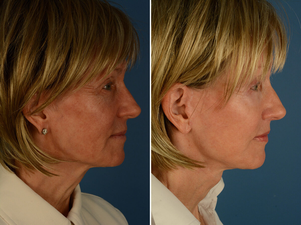 Lip Lift Before and After Photos in Naples, FL, Patient 31694
