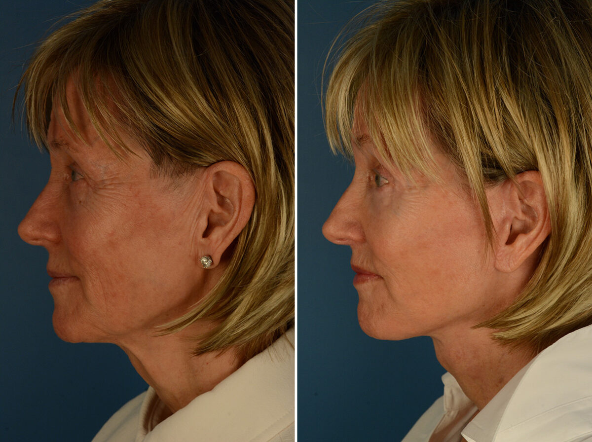 Lip Lift Before and After Photos in Naples, FL, Patient 31694