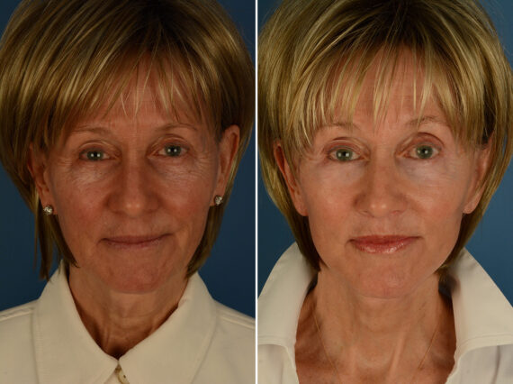 Lip Lift Before and After Photos in Naples, FL, Patient 31694