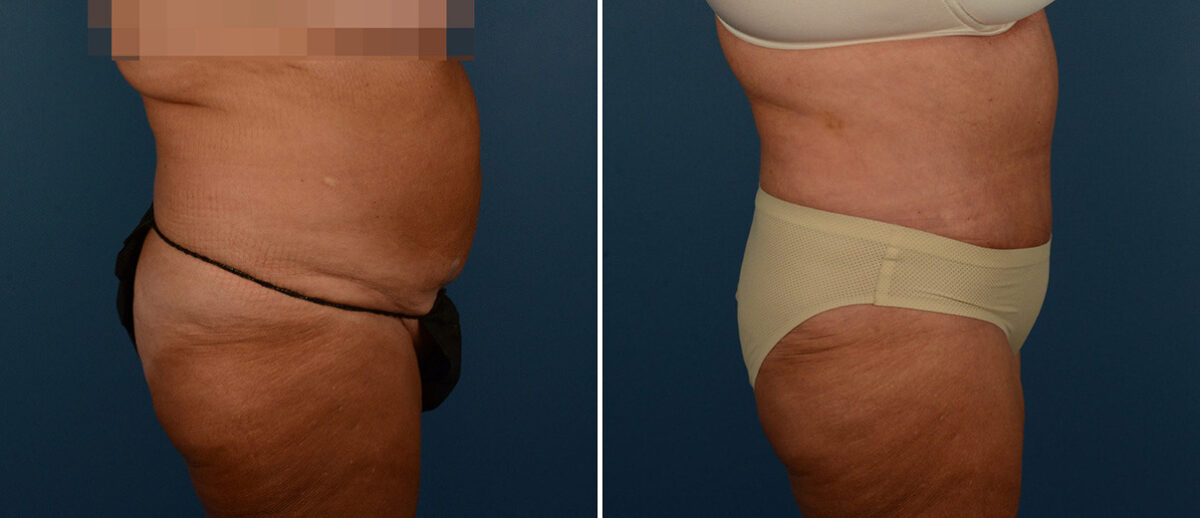 Abdominoplasty Before and After Photos in Naples, FL, Patient 21725