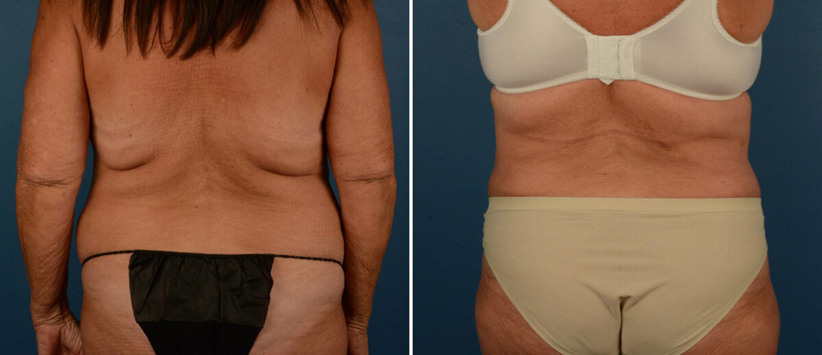 Abdominoplasty Before and After Photos in Naples, FL, Patient 21725