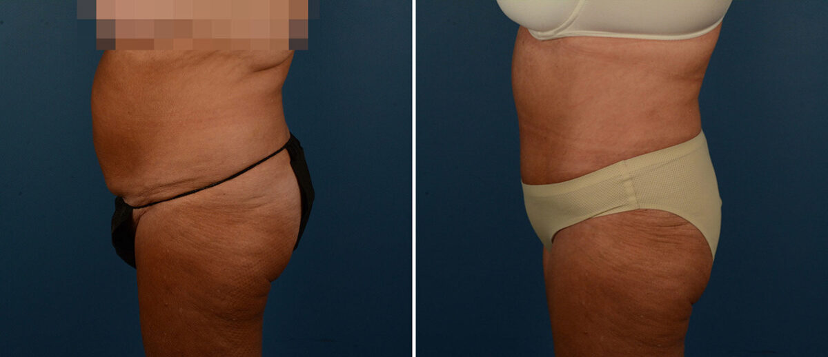 Abdominoplasty Before and After Photos in Naples, FL, Patient 21725