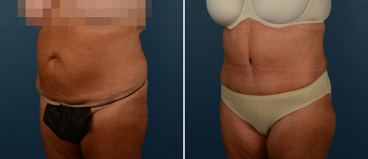 Abdominoplasty Before and After Photos in Naples, FL, Patient 21725