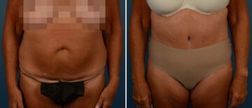 Abdominoplasty Before and After Photos in Naples, FL, Patient 21725