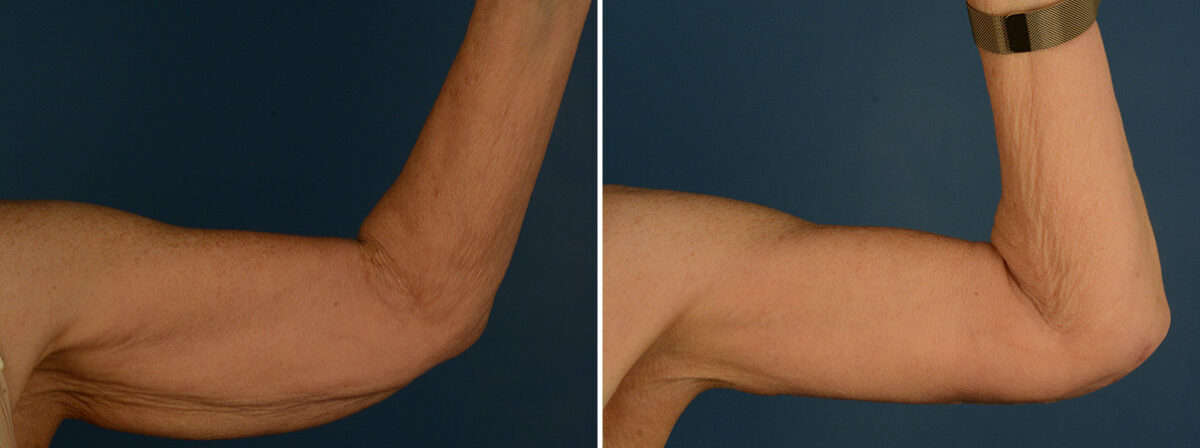 Arm Lift Before and After Photos in Naples, FL, Patient 31926