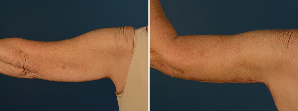 Arm Lift Before and After Photos in Naples, FL, Patient 31926