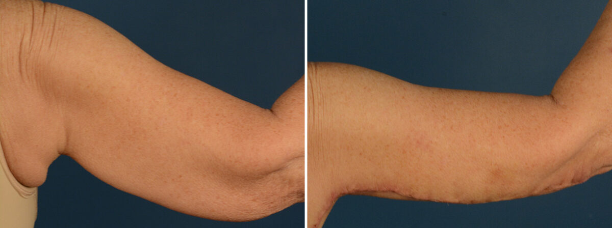 Arm Lift Before and After Photos in Naples, FL, Patient 31926