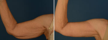 Arm Lift Before and After Photos in Naples, FL, Patient 31926