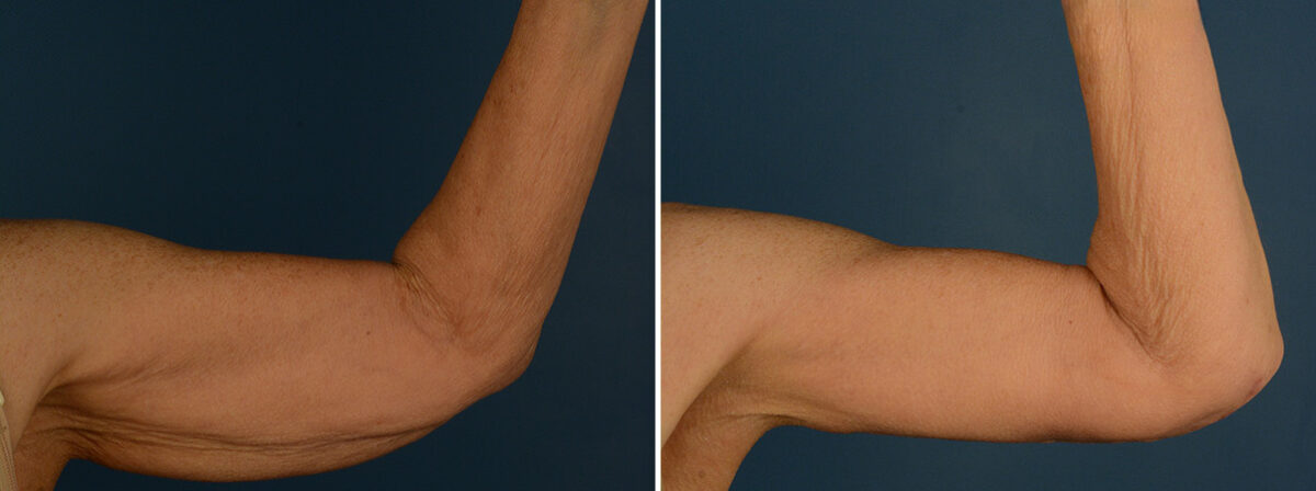 Arm Lift Before and After Photos in Naples, FL, Patient 31926