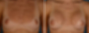 Breast Augmentation Before and After Photos in Naples, FL, Patient 31940