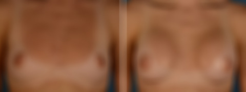 Breast Augmentation Before and After Photos in Naples, FL, Patient 31940