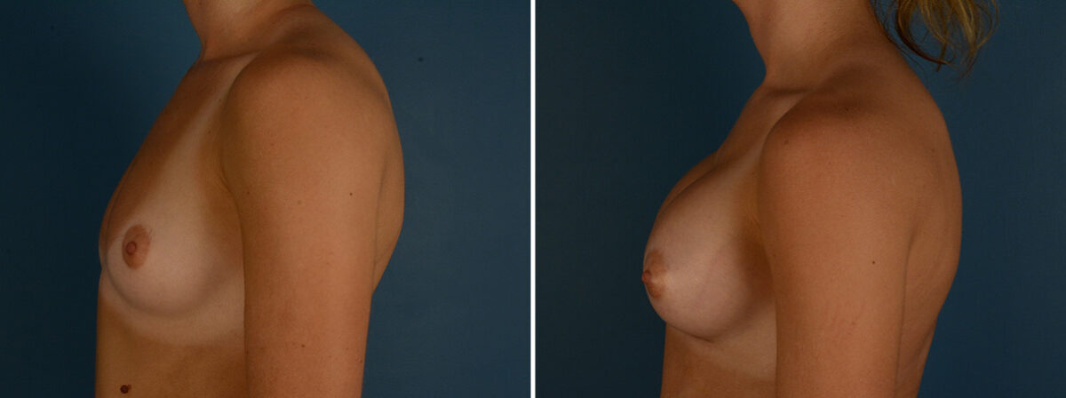 Breast Augmentation Before and After Photos in Naples, FL, Patient 31940
