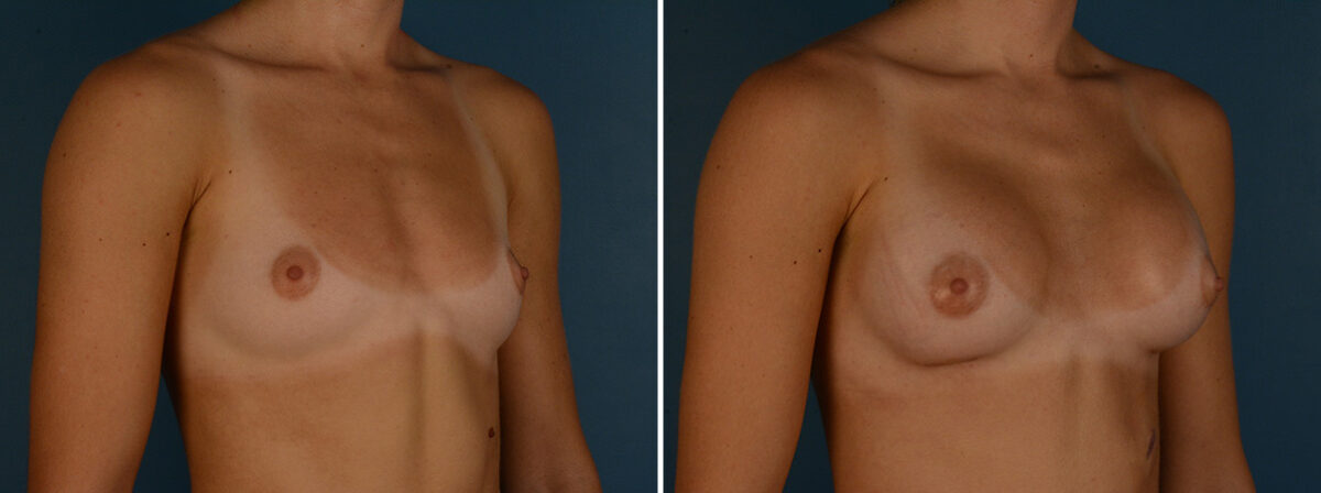 Breast Augmentation Before and After Photos in Naples, FL, Patient 31940
