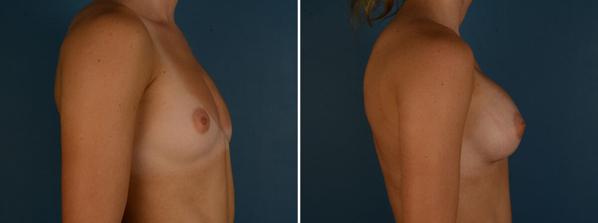 Breast Augmentation Before and After Photos in Naples, FL, Patient 31940